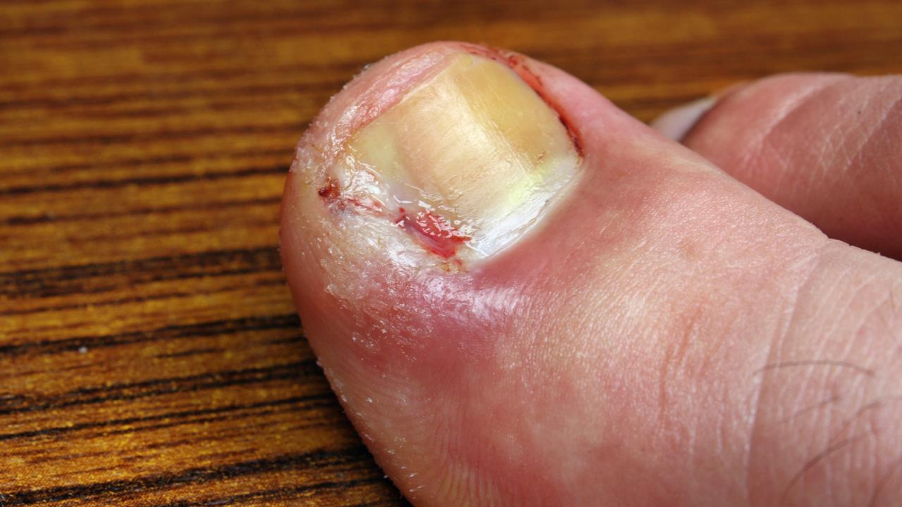 More than 400 people have gone to emergency departments this year with ingrown toenails.