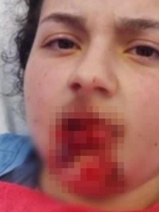 Niki suffered severe facial injuries in the dog attack. Picture: 7News