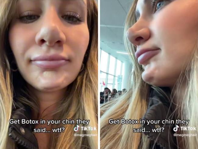 'I got botched botox - it's frozen my face and I can't move my chin.' Picture: TikTok