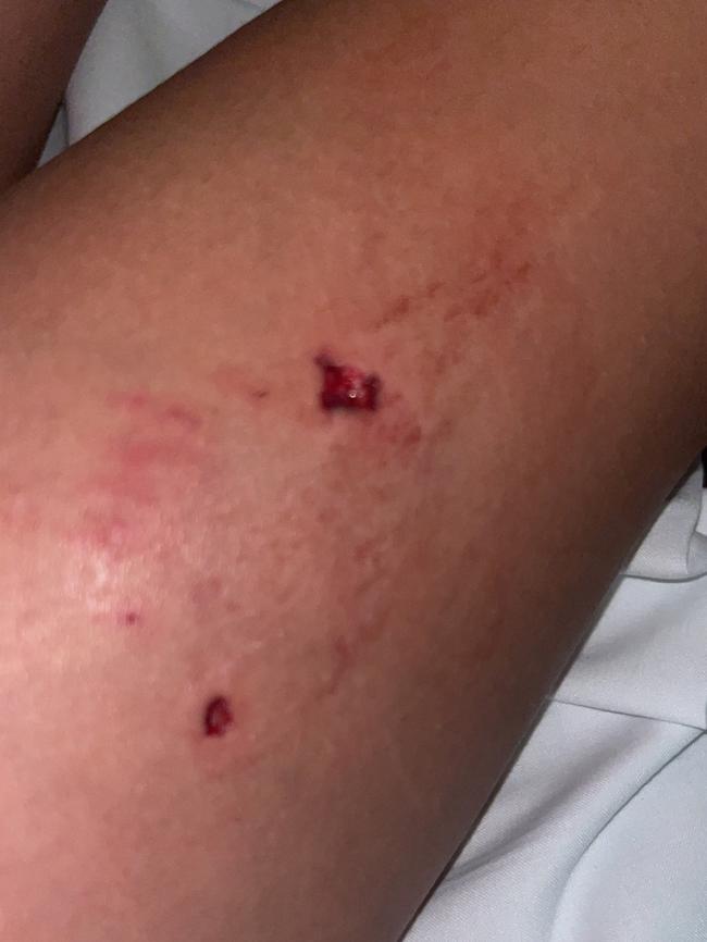 Ms Briston said Kaidence’s wounds had not healed two weeks later. Picture: Supplied.