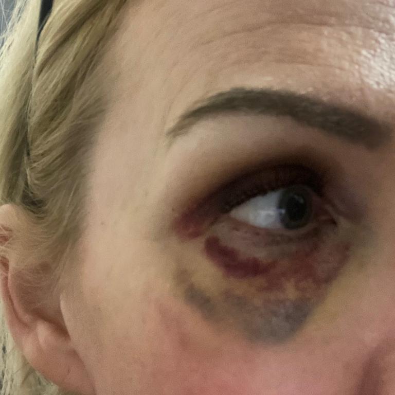 Anna Dean’s eye after one of Rose’s violent episodes.