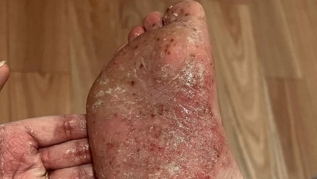 Nicole Preece, 34, is suffering with rare form of eczema causing huge blisters on her hands and feet. Pictures: Supplied