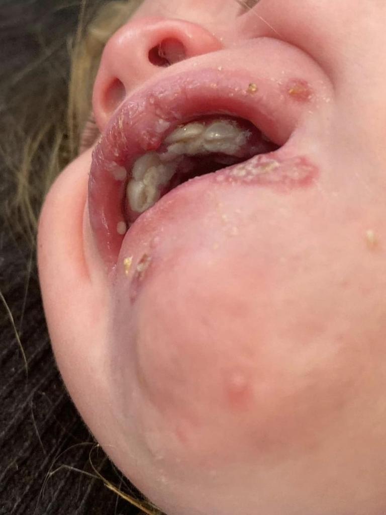 As well as images of common sicknesses in children, like this one of a child who developed a cold sore after being kissed. Picture: Instagram/Tiny Hearts Education.