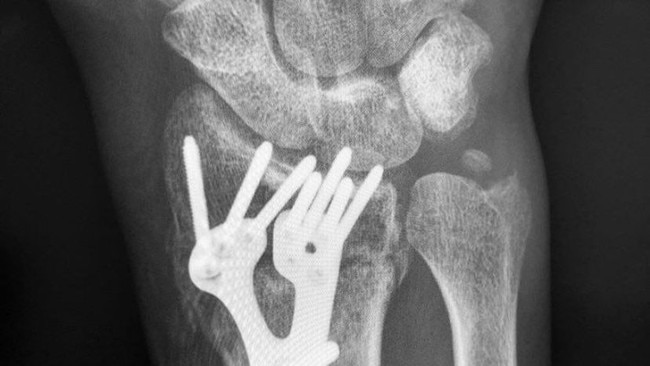 An X-Ray of Ali Day's broken wrist. Supplied.