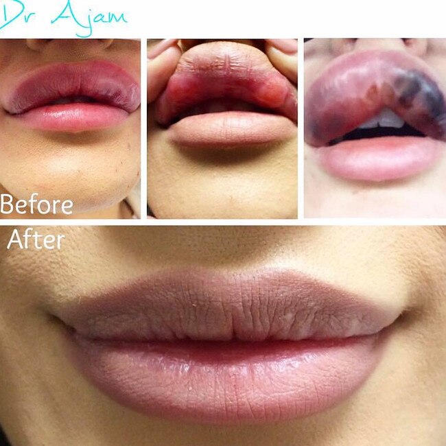 This woman’s lips were infected after having permanent filler injected, which was fixed by Dr Alie Ajam. Picture: Age Reduxion Clinic