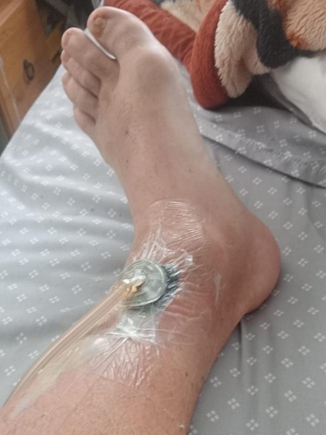 Chris Herbert required skin graft on his ankle. Picture: Supplied
