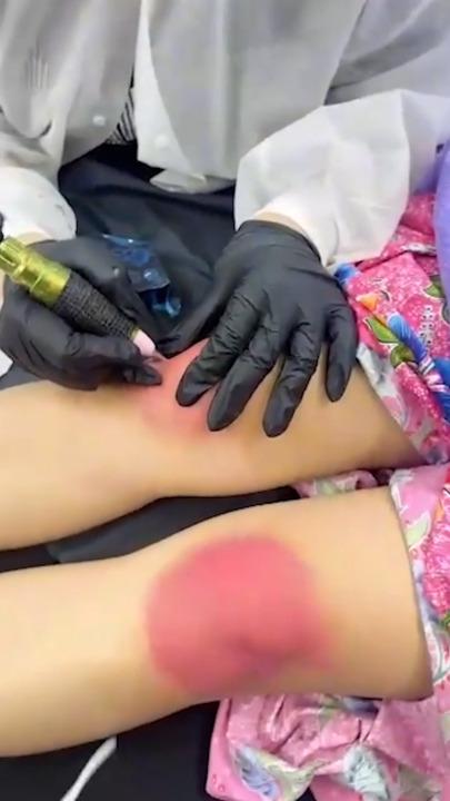 Beauty clinic gives bizarre pink kneecap tattoo treatment