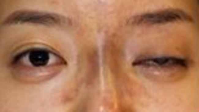 A South Korean woman who went blind in one eye after getting dermal filler injected.