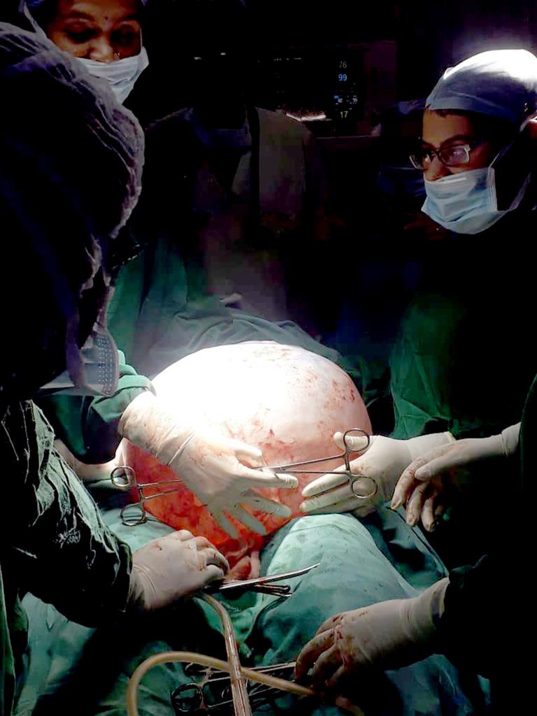 The moment the medical team removed the gigantic pumpkin-shaped tumour. Picture: Caters