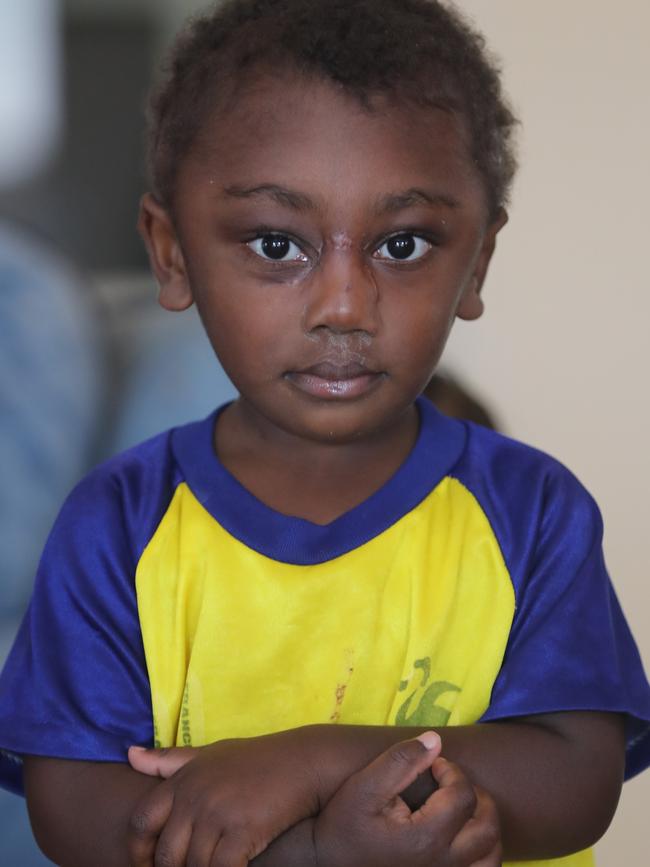 The little boy was flown to Melbourne for life-changing surgery. Picture: Alex Coppel