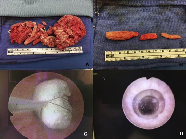 The doctors shared photos of the foam being removed and outside of the body. Picture: Urology Case Reports