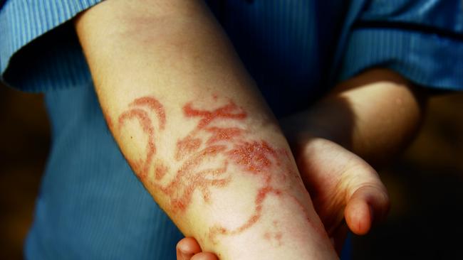 Another boy, Benjamin Horsington (6), returned from a Bali holiday with his father with a ‘black henna’ tattoo which left scars on his arm along with lifelong allergies due to the chemicals used with black-henna.