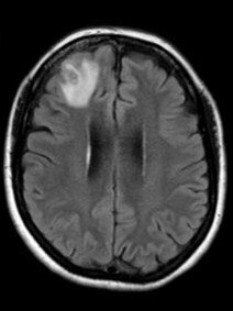 A NSW woman was admitted to Canberra Hospital after suffering with unexplained symptoms for more than a year. Picture: CDCP