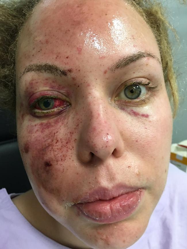 Facial injuries she sustained from a police flash grenade