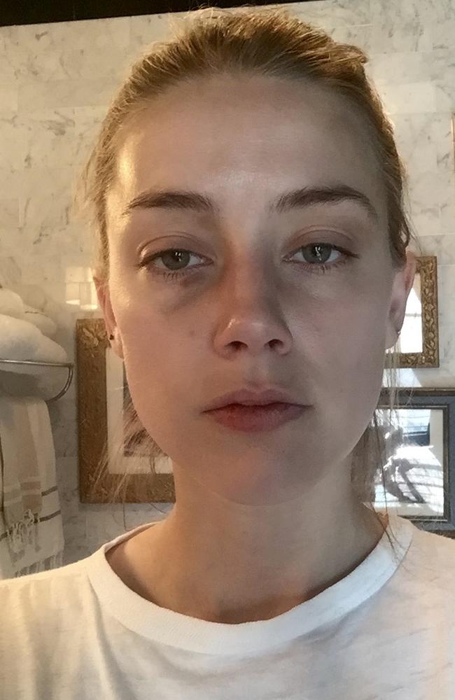 Amber Heard shared photos of her injuries she claimed happened as a result of a headbutt.