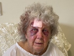 83-year-old Alma Brooks, she sustained mysterious bruises while being cared for at Hornsby Hospital., Picture: Supplied by family