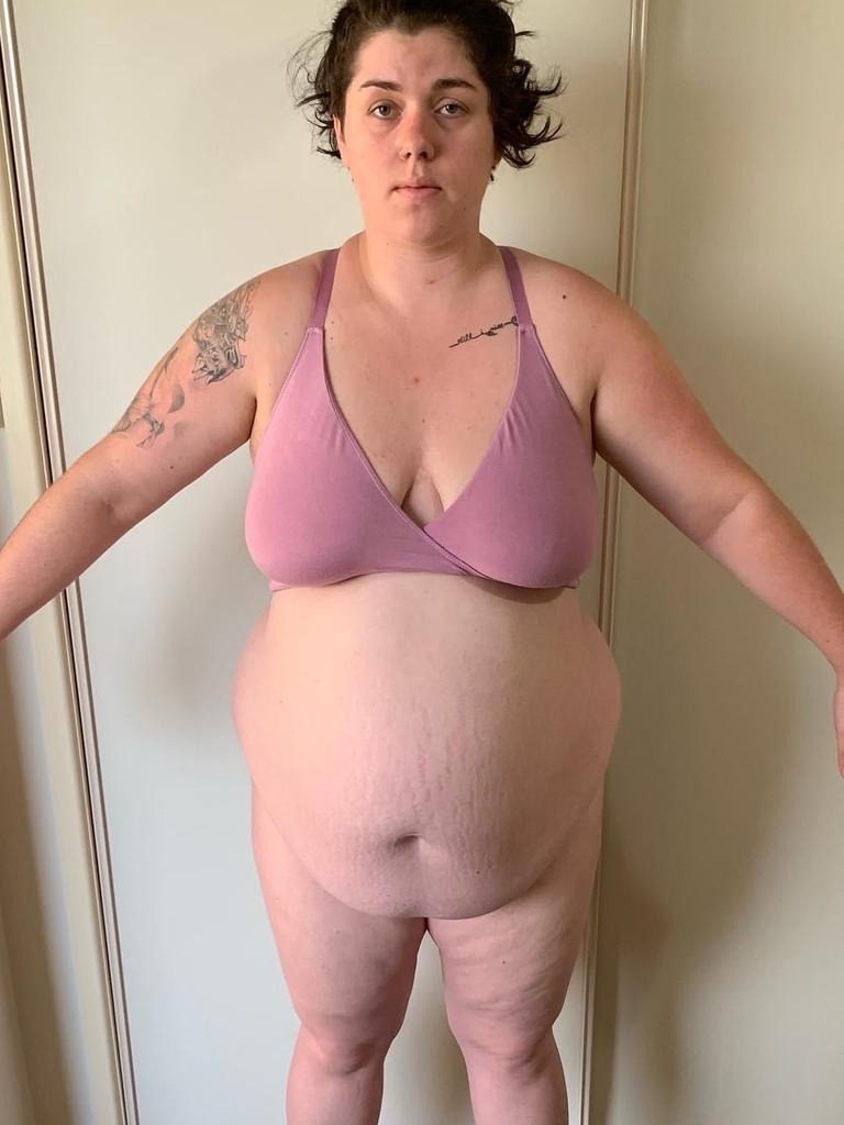 Before her weight loss surgery, Jemma Preston tipped the scales at 130kg but this mother of two warns that surgery is not a magical solve-all solution.