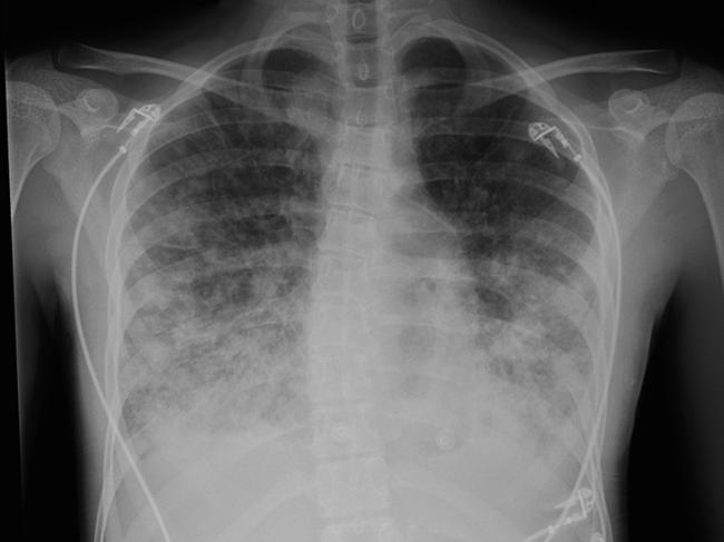 An X-ray of an Aussie teen’s lungs damaged by vaping. It comes from a Medical Journal Australia article in 2021. Picture: Supplied