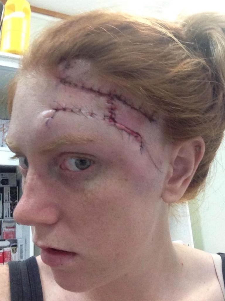 Nicole Geisler had a stage 2 melanoma removed from her forehead at the age of 19. Contributed