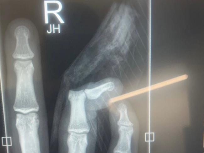 The x-ray that shows Riley Reid’s badly dislocated finger, which he suffered while playing for the Rockhampton Rustlers at the 47th Battalion.