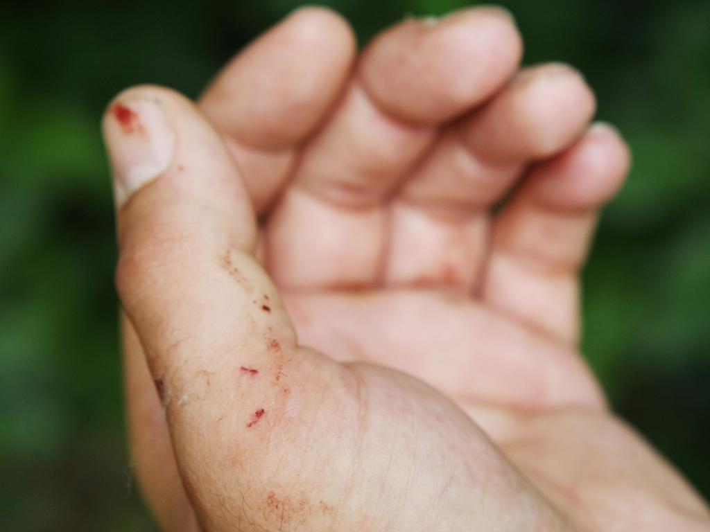 Beenleigh man Malcolm Biggs was bitten three times by a red-bellied black snake when he picked it up to move it off the road.