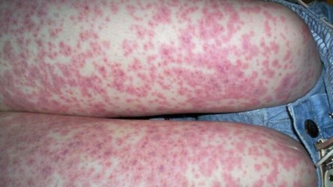 SA Health has issued an alert with two people in a critical condition with the B strain of meningococcal disease. Source: Supplied.