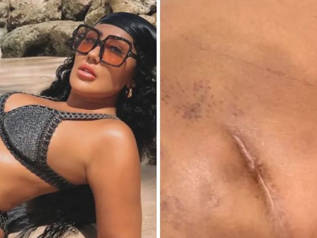 A legend from reality series Geordie Shore has opened up about a botched Brazilian butt lift that ‘nearly killed’ her.