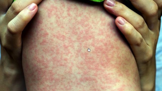 The measles rash usually begins 3-7 days after the first symptoms.