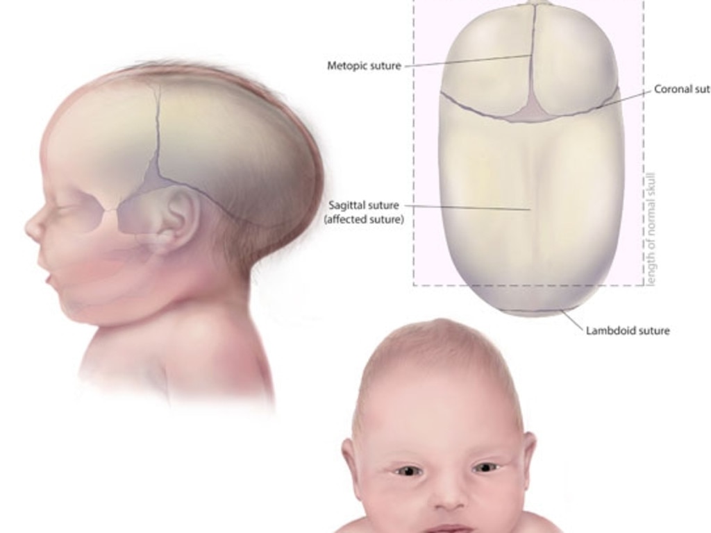 Почему голова вытянутая. Сагиттальный шов черепа новорожденного. Краниостеноз формы черепа. Форма головы сбоку младенца. Коронарный краниостеноз.