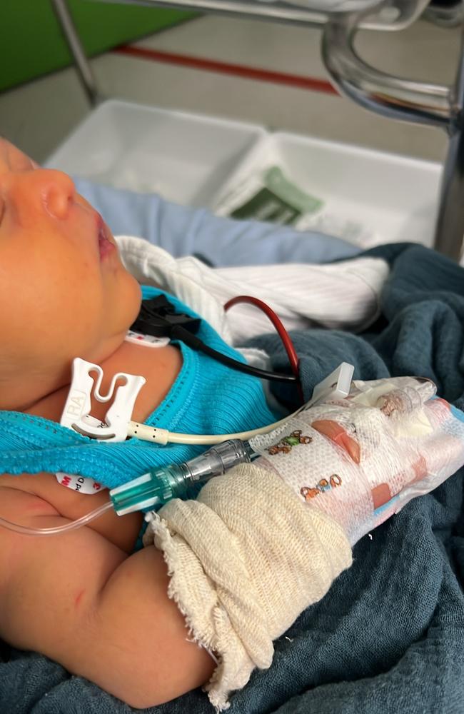 Nine-week-old Azai in the Mackay Base Hospital after a diagnosis of the KCNT1 gene. Photo: Supplied