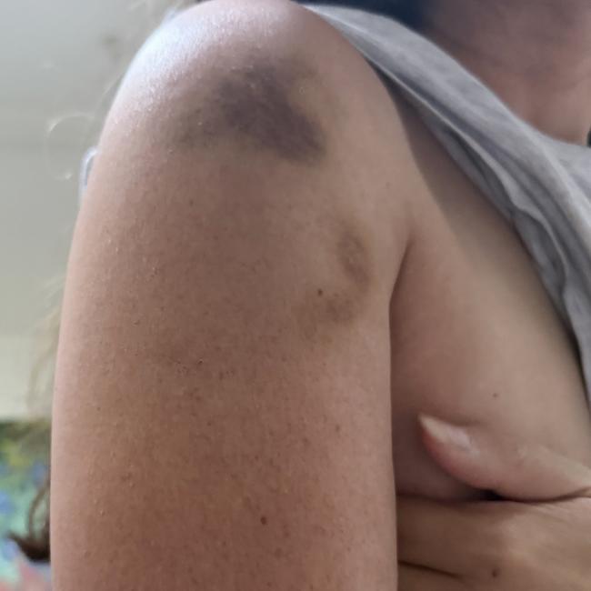 Bruising allegedly inflicted by a home invader