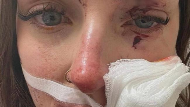 Taiya Sampson was left with a deep gash on her cheek, stitches in her forehead and blood smeared on her face after she was allegedly glassed in an Alkimos pub in Perth. (9News)