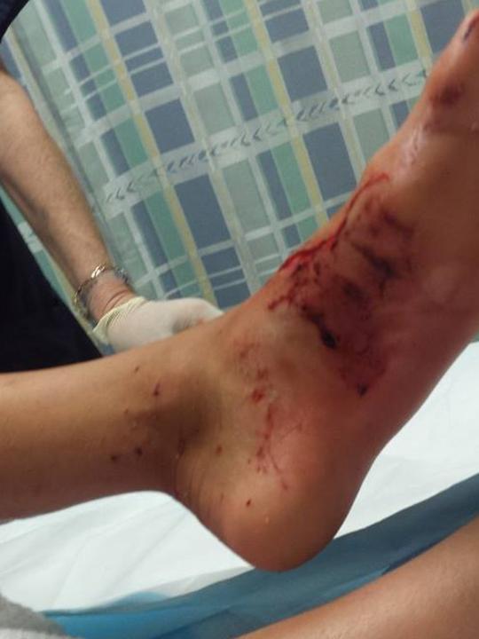 Facebook image of Kirra-belle Olsson after she was attacked by a shark at Avoca Beach.