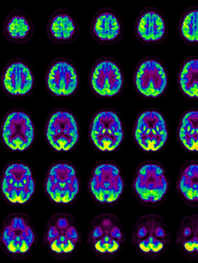 PET scan images show the cortisol-producing enzyme in the brain, which the Xananem pill targets.