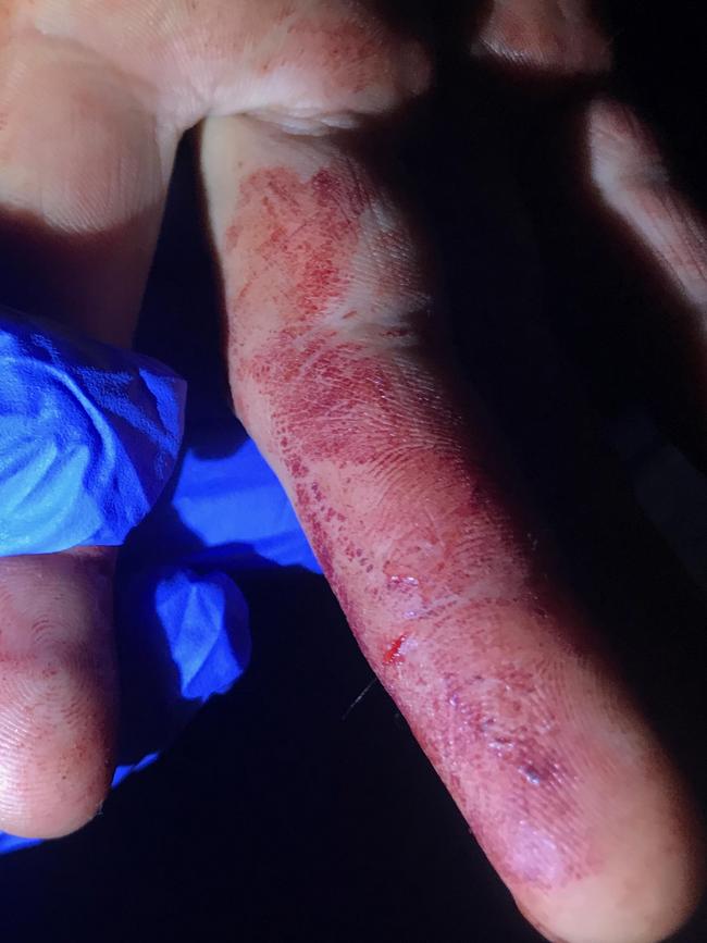 A cut on Mehdi Cheraghi’s finger which was assessed by police.