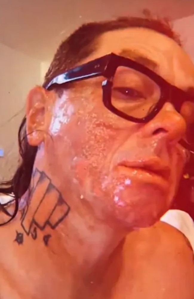 The Slipknot rocker has shared gruesome pictures of his shocking injury. Picture: Instagram