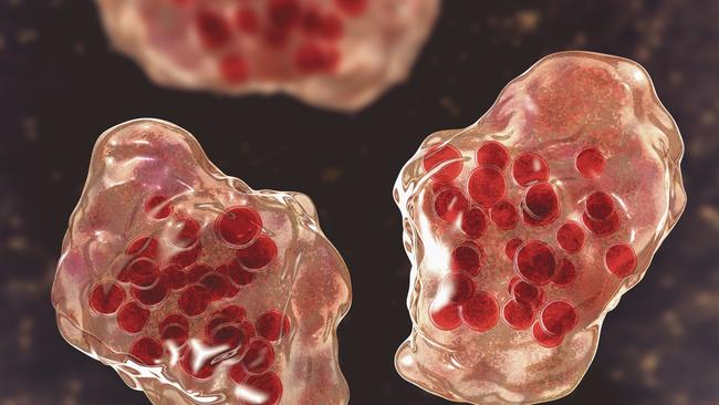 Illustration of measles virus infection showing giant multinucleated cells seen during microscopy of biopsy specimens, known as Warthin-Finkeldey giant cells.