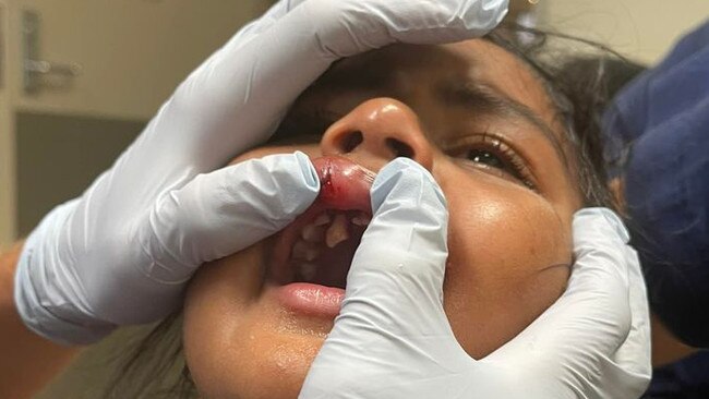 The mother of a two-year-old girl who suffered tooth damage at a childcare centre at Avoca says the centre failed to provide adequate first aid and did not notify her when the incident occurred.