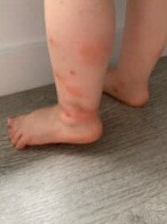 Charlotte is allergic to mosquitoes. Photo: Supplied