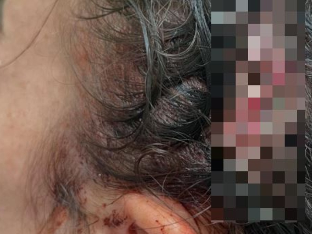 Rhiannon Purcell needed three staples to close a 4cm gash on the back of her head.