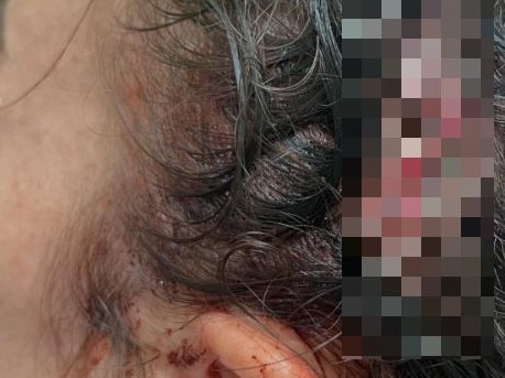 Rhiannon Purcell needed three staples to close a 4cm gash on the back of her head.