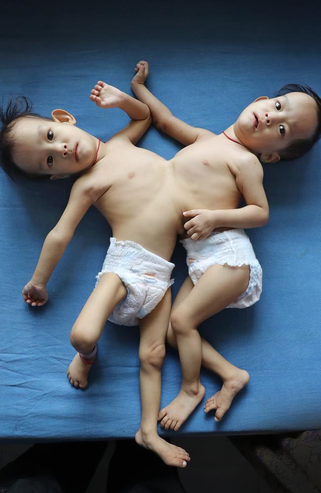 Conjoined twins Nima and Dawa are to be flown to Australia to have lifesaving surgery. Picture: Alex Coppel