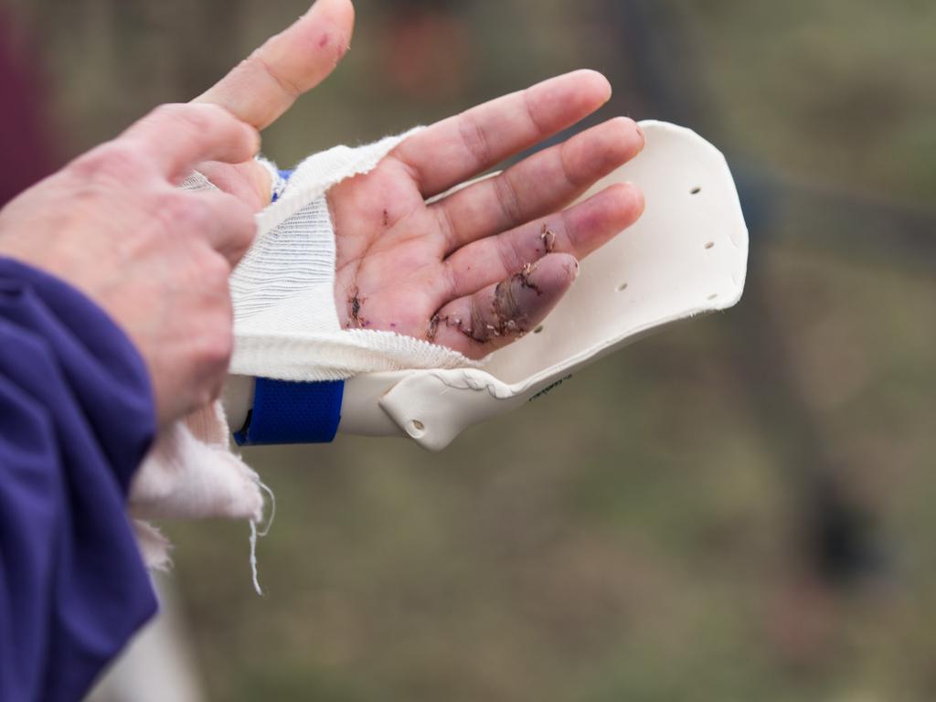 Ms Gore said doctors told her it was ‘no guarantee’ she would regain sensation in her left pinky finger after she was allegedly stabbed. Picture: NCA NewsWire/Paul Jeffers