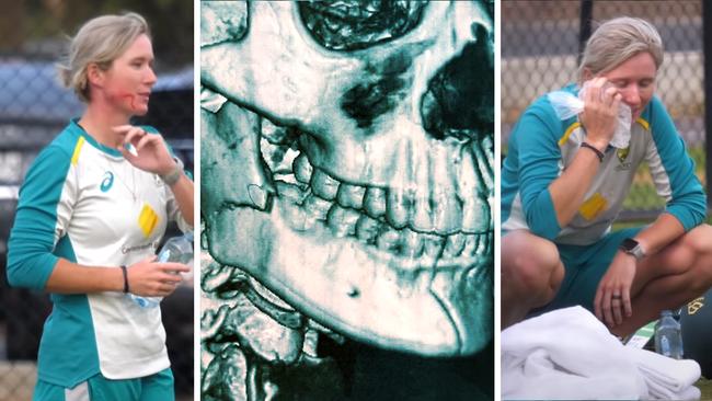 Beth Mooney's remarkable toughness to battle on after breaking her jaw.