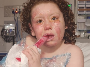 Daniella Jacobs-Herd suffered serious burns in an incident at her Urangan home.