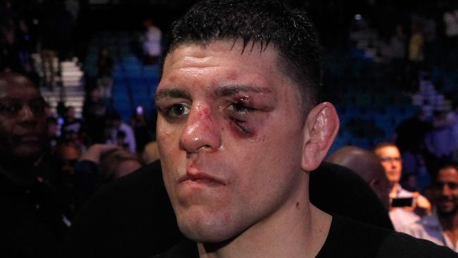 Nick Diaz after losing to Anderson Silva at UFC 183.