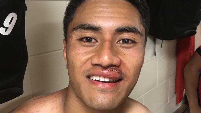 Tonga halfback Ata Hingano with 10 stitches in his lip following the Scotland clash.