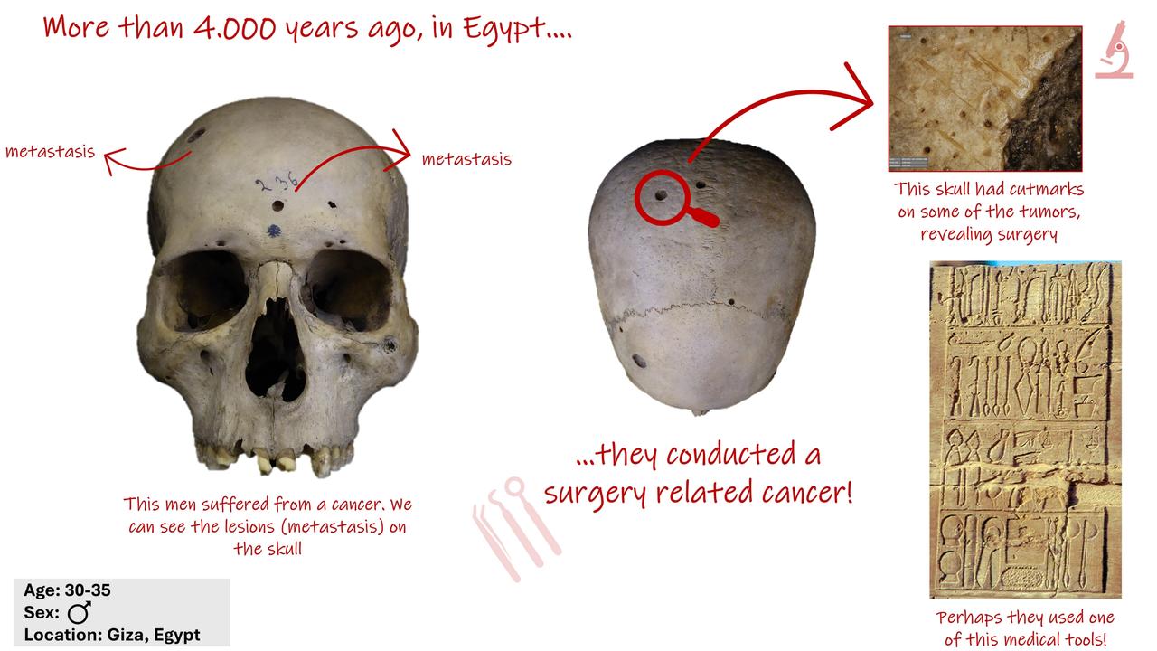 An ancient skull of an Egyptian man aged 30-35 had cut marks that related to cancerous tumours. Picture: Dr Edgard Camaros