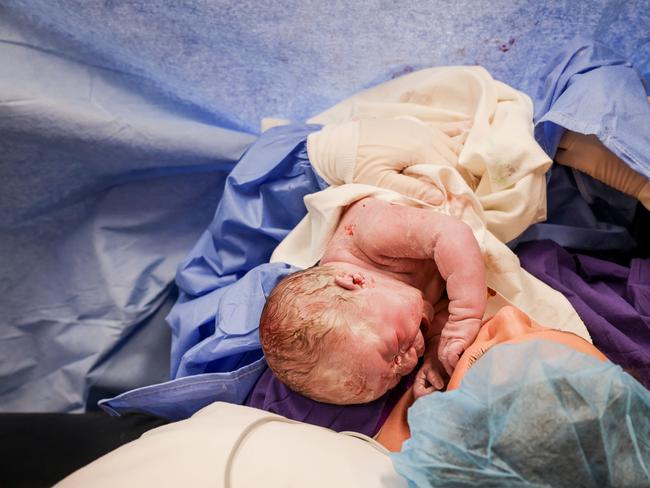 Maternal assisted caesarean allows mothers to be more invovled in the delivery.