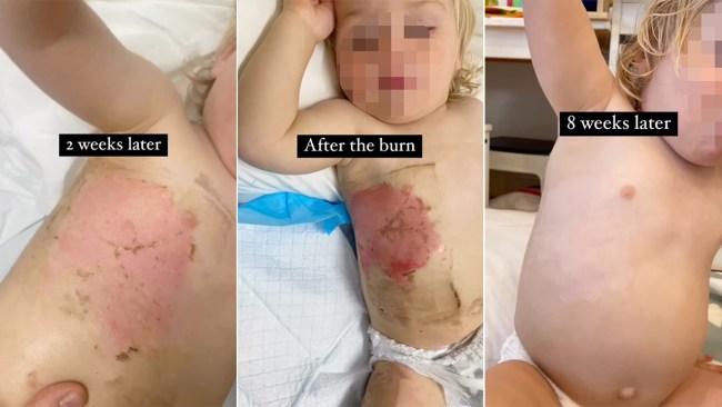 Good recovery from a burn relies on good first aid. Photo: Instagram